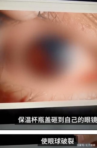 危險！女生保溫杯泡紅棗被炸傷眼球：無知的養生，就是慢性自殺