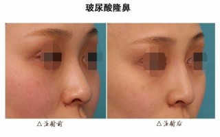 玻尿酸填充 微調之中自有妙處