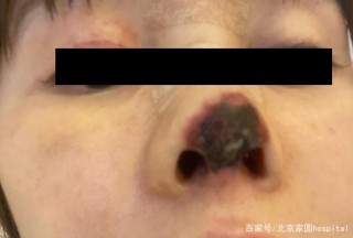 女演員高溜自曝整容失敗鼻尖壞死，有時候愛美需要學