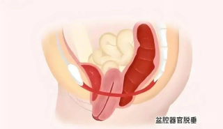 女性盆腔器官脫垂：了解這個影響生活質量的 “小麻煩”_治療_症狀_陰道