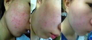痘痘、蟎蟲困擾？每晚塗一塗藥店裡的白色「乳膏」，皮膚嫩滑如水