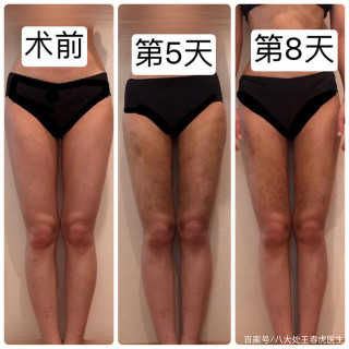 大腿環吸案例