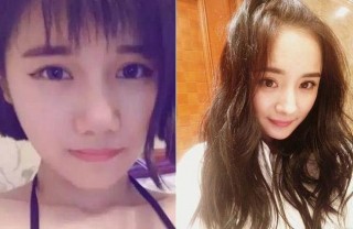 女生花百萬整成楊冪 手術後臉腫到眼睛幾乎睜不開