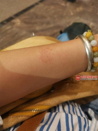 南寧一女子“吸貓”被感染貓癬，醫生提醒：養寵物要當心人畜共患病