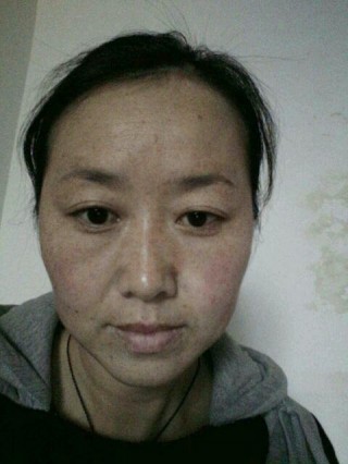 開塞露祛斑很簡單，很多人都不相信，裡面多加點「它」，祛斑只幾天