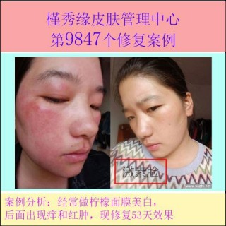 激素臉的五大分類!——槿秀緣皮膚管理修復案例連載010