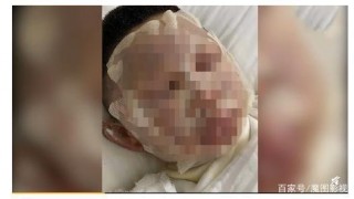 科學實驗導致4名小學生被II度燒傷！學校到底該不該上科學課？