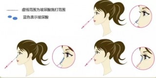 關於鼻整形，你不知道的一些內幕！